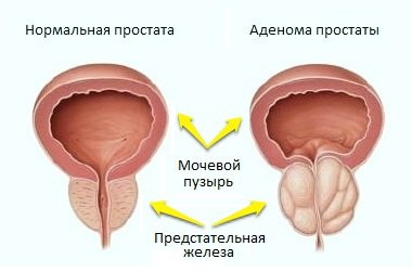 Аденома предстательной железы (простаты)